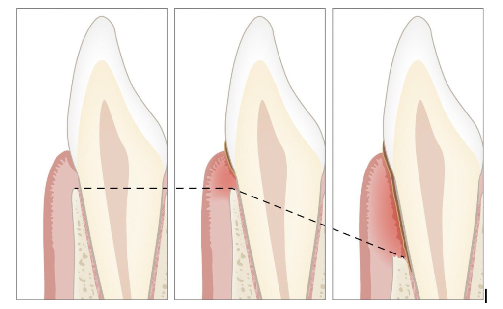 Parodontita: Ce trebuie să știi despre această afecțiune inflamatorie 2 Tartru parodontoza