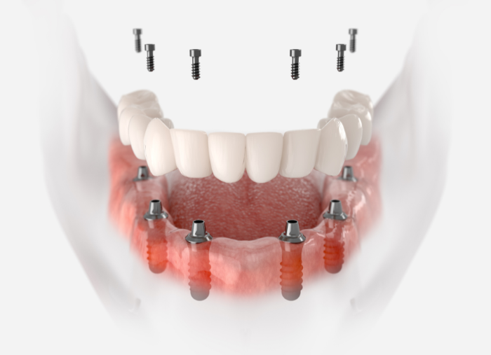 Componente implant dentar: implant, bont și coroană 3 compnente dinti ficsi