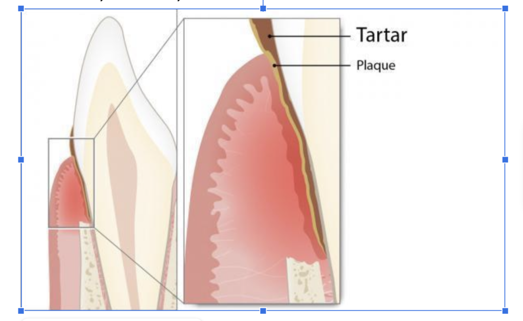 Parodontita: Ce trebuie să știi despre această afecțiune inflamatorie 3 factori local parodontoza