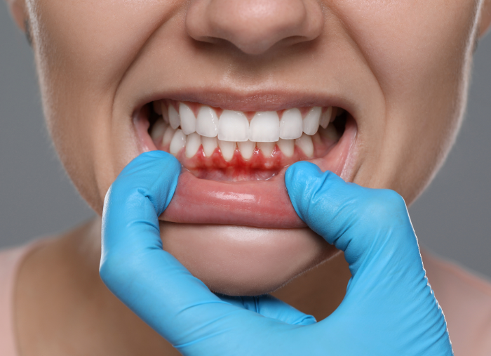 Parodontita: Ce trebuie să știi despre această afecțiune inflamatorie 4 Parodontoza