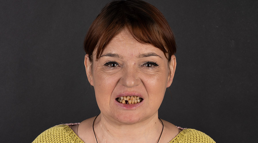 Implant unitar — înainte