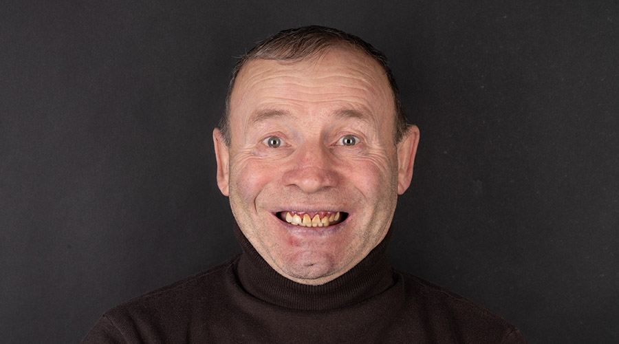 Reabilitare orală completă — înainte