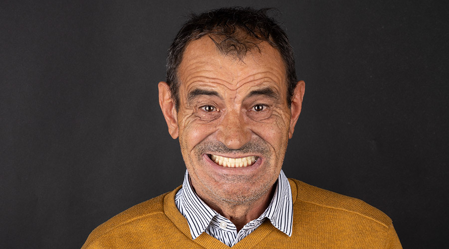 Ortodonție invizibilă — după