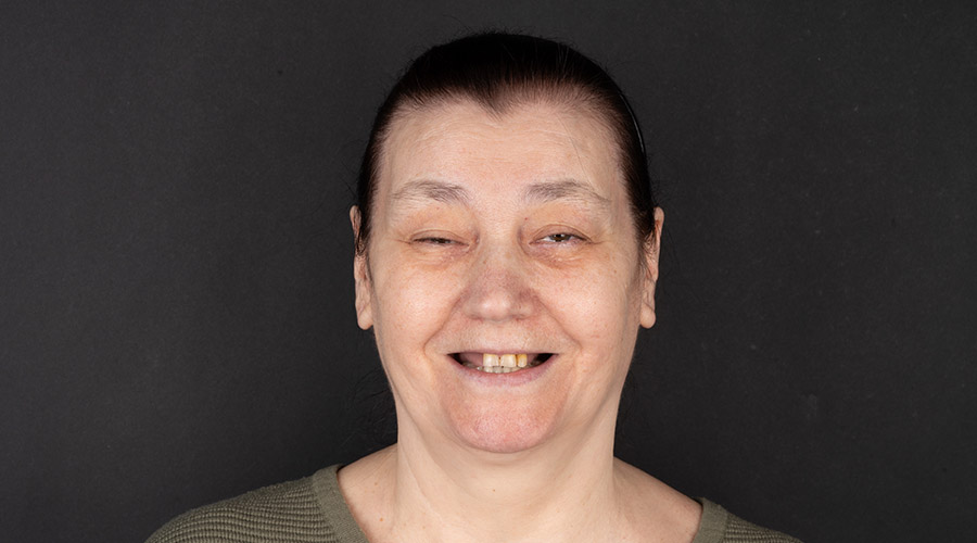 Coroane ceramice — înainte