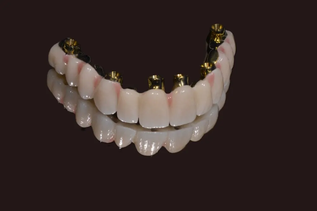 Coroane dentare — protecție și estetică pentru dinții afectați