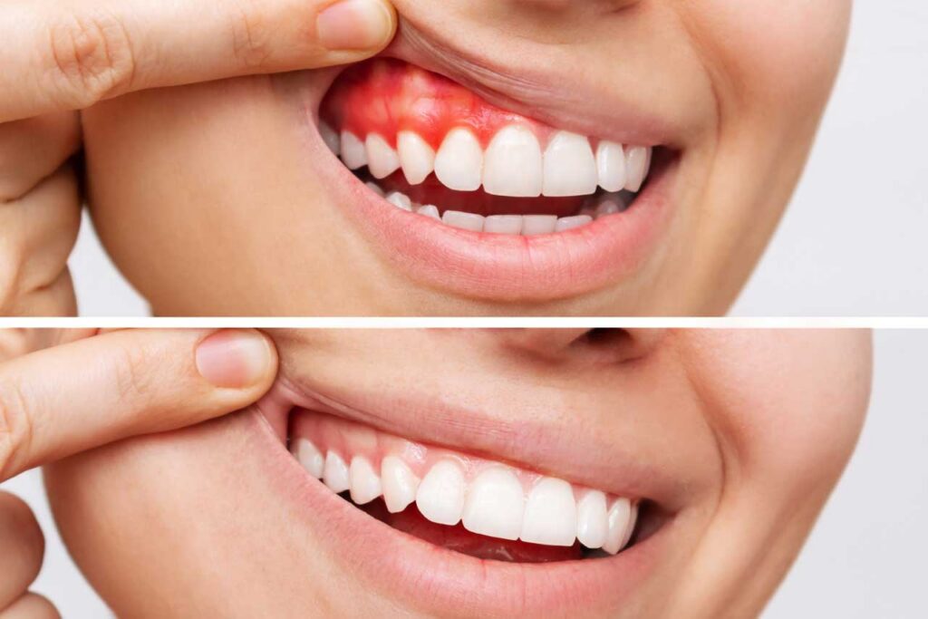 Tratamentul parodontozei la FAV Dental Clinic