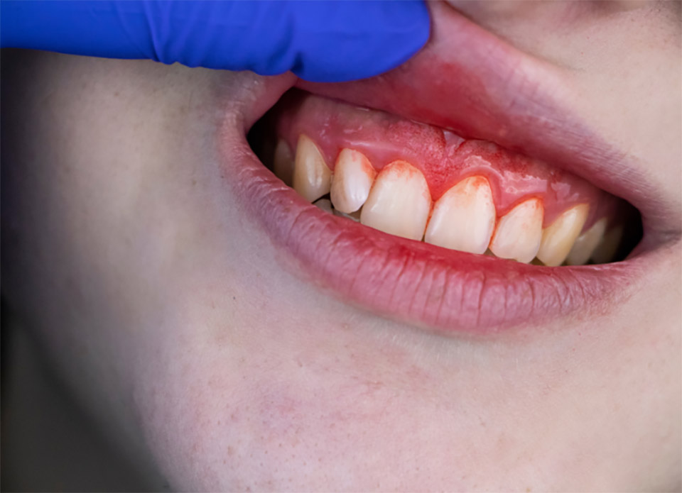 De ce sângerează gingiile? Află care sunt cauzele
