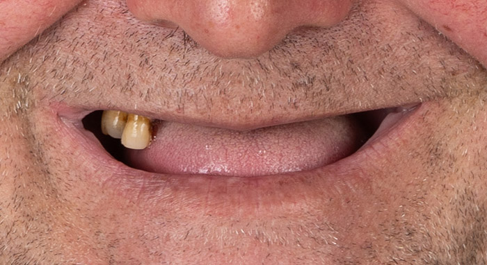 Aveți pierderi dentare extinse pe o arcadă sau pe ambele, iar funcția de masticație este afectată.