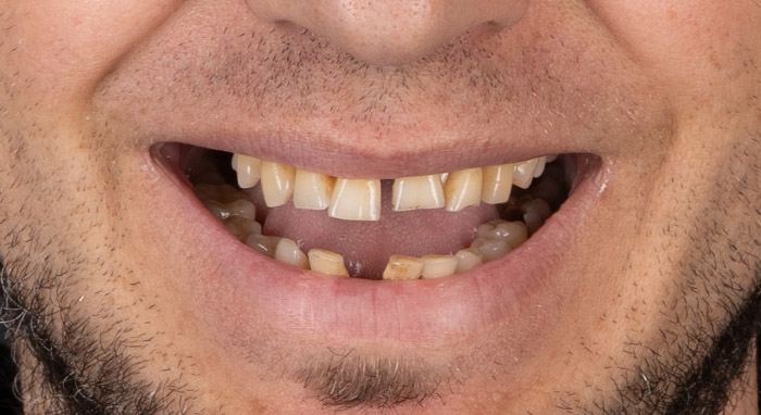 Dinții rămași nu mai pot fi menținuți pe termen lung, în special în cazuri de parodontoză avansată, mobilitate dentară sau infecții recurente.