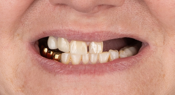 Ați avut lucrări dentare repetate fără rezultat stabil, când coroanele, punțile sau protezele existente nu mai oferă confort sau durabilitate.